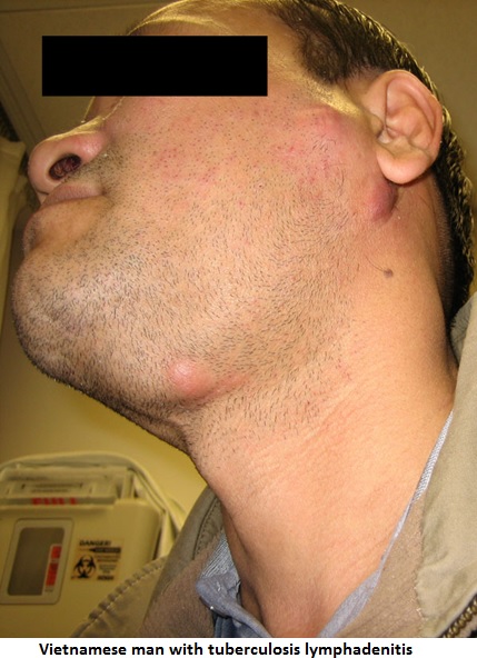 swollen lymph nodes in groin hiv