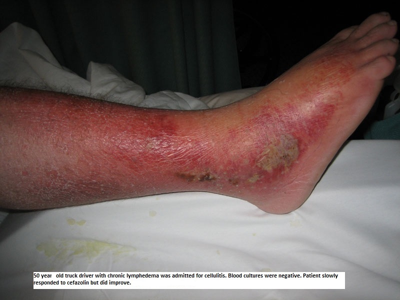 Cellulitis-Topic Overview – WebMD