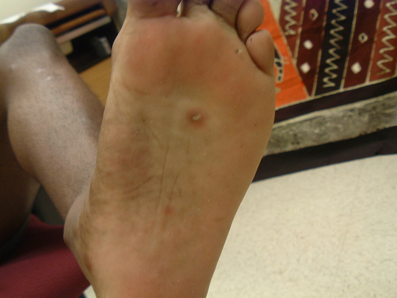 hiv rash feet