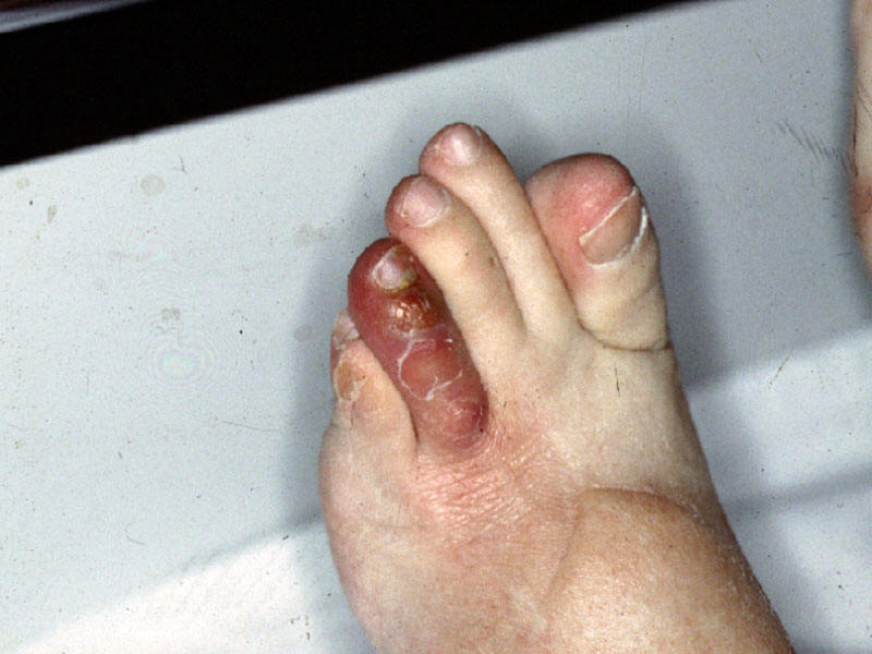 Ungueal and toe infection due to disseminated Fusarium during a ...